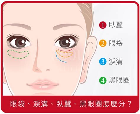 笑起來眼袋很大|臥蠶還是眼袋？那些關於眼袋手術的秘密